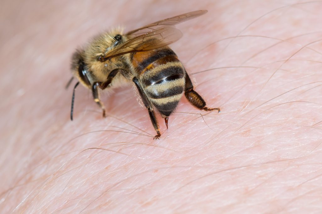 bee sting therapy